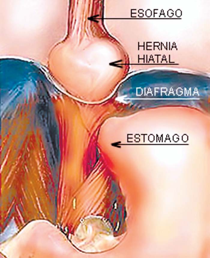 Que comer cuando se tiene hernia de hiato